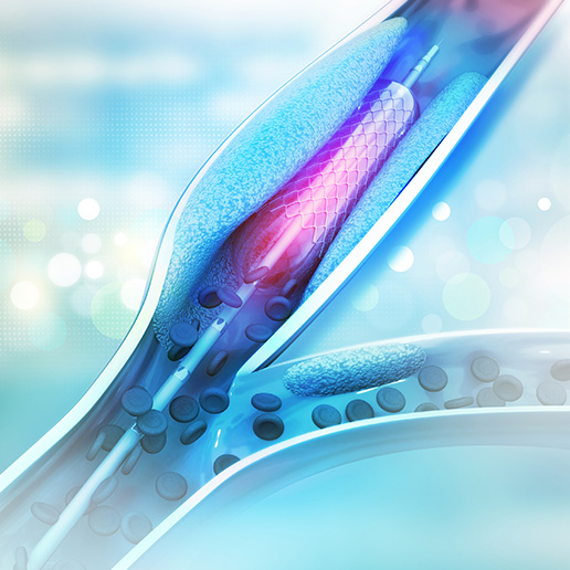 Visual representation of a stent angioplasty procedure using a catheter with a balloon tip.