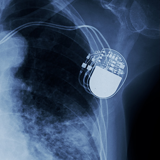 X-ray of a pacemaker in a person