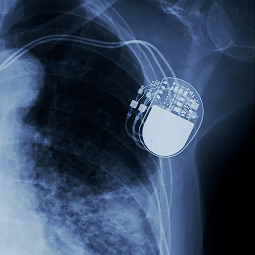 laser wire ablation systems for implantable devices - xray of implantable